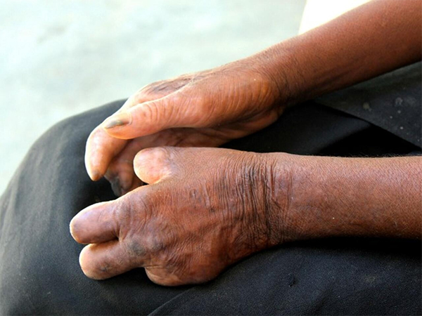 Maladies tropicales négligées et de la lèpre : Le Sénégal veut éliminer les Mtn d’ici 2030